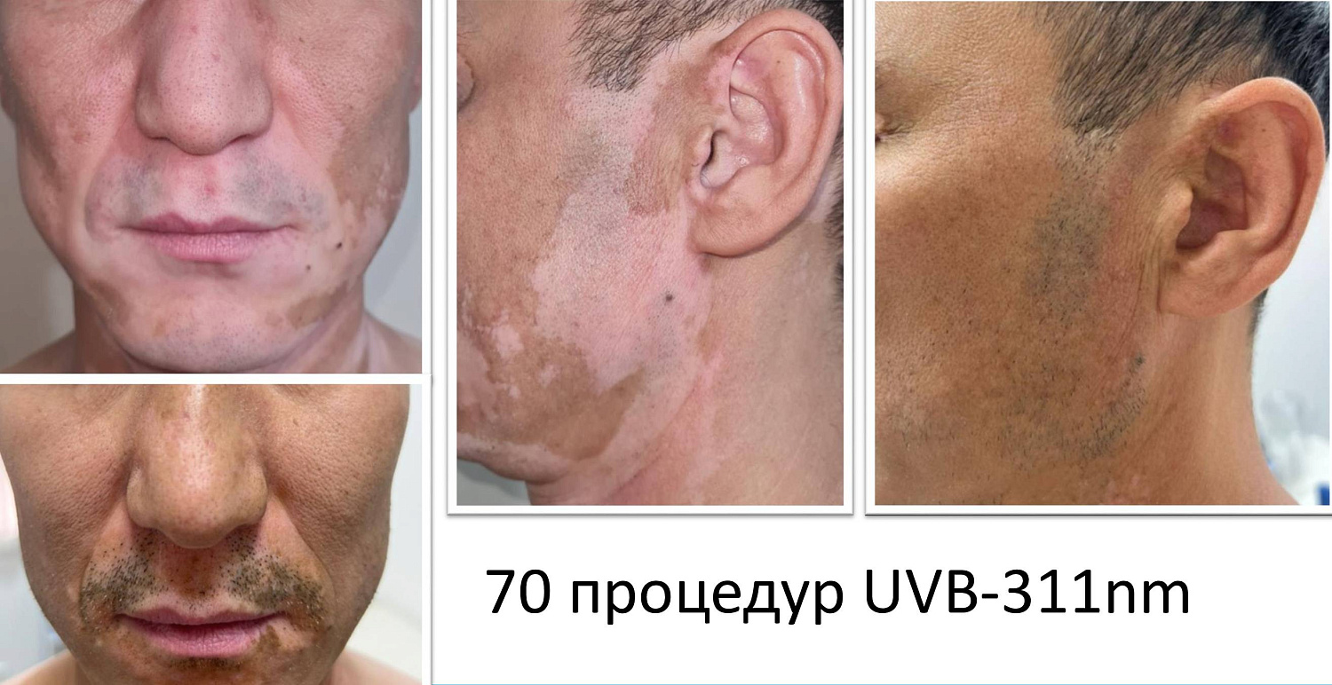 Результаты лечения